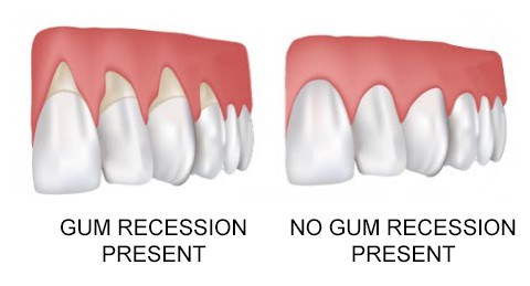 Gum-Recession – Advanced Implants & Periodontics